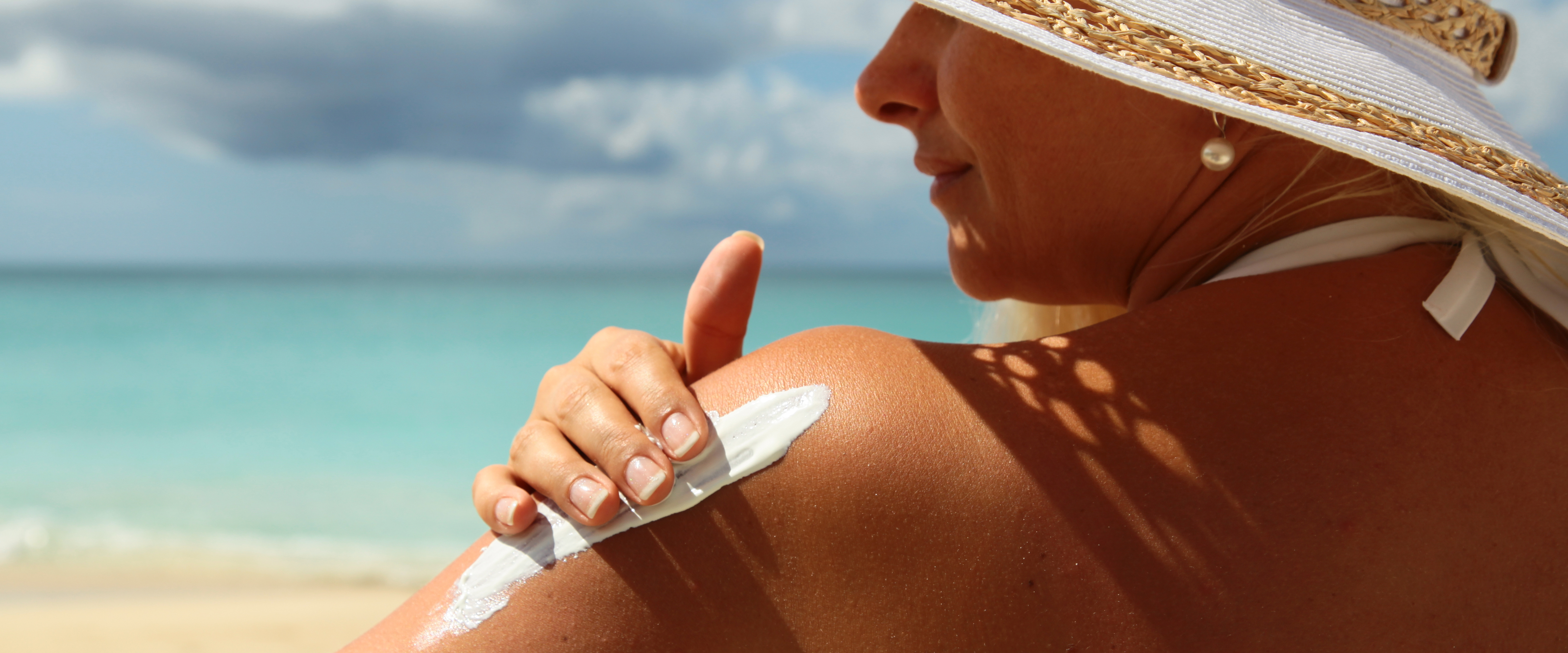CBD for sunburn